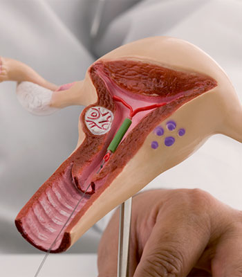 intrauterine-insemination