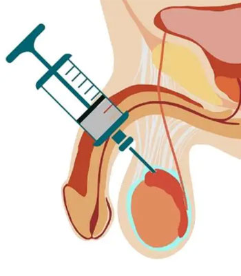 testicular sperm aspiration